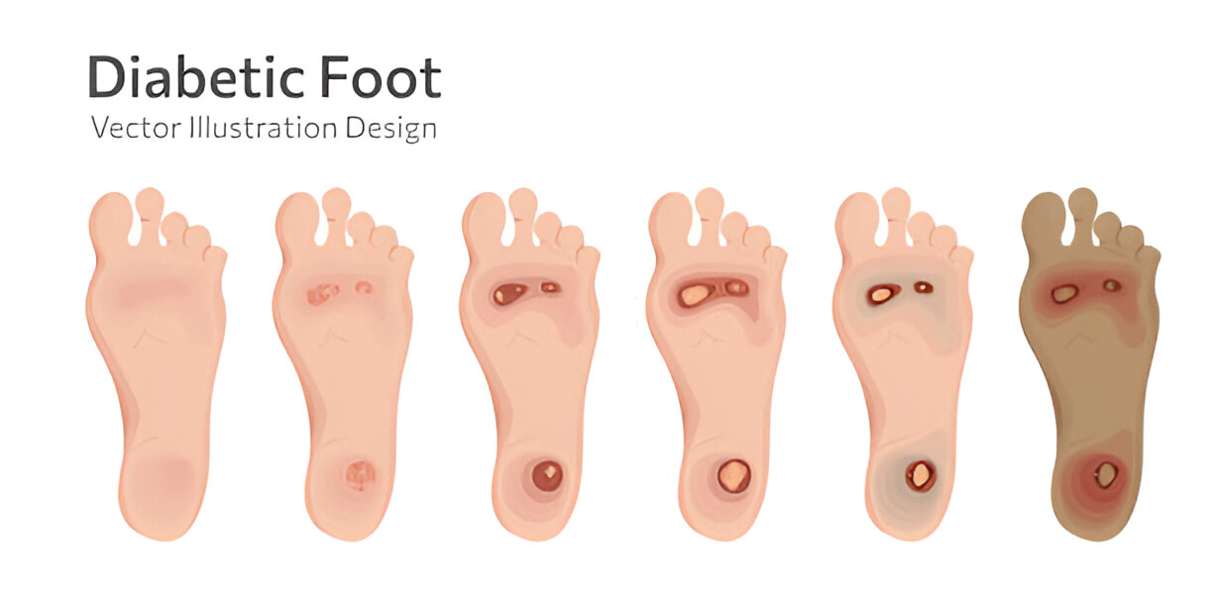 Diabetic Foot
